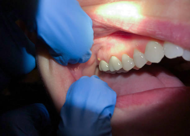 Best Emergency Treatment for Dental Infections or Abscesses in Morgantown, WV